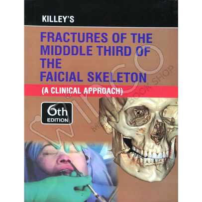 Killeys Fracture of the Middle Third of the Facial Skeleton