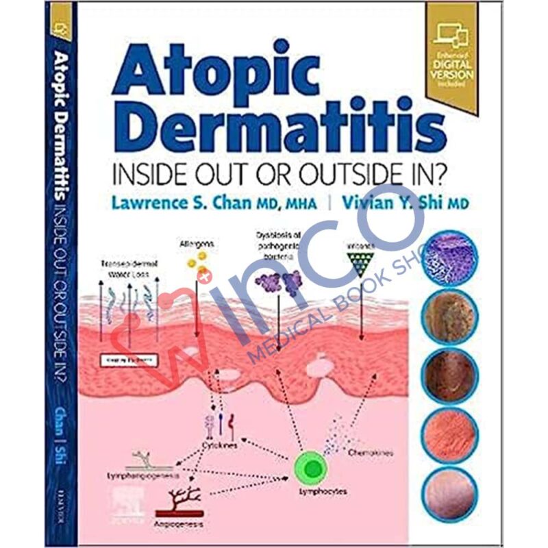 Atopic Dermatitis: Inside Out or Outside In 1st Edition