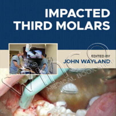 Impacted Third Molars, 2nd Edition