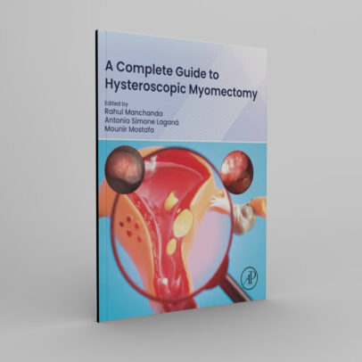 A Complete Guide to Hysteroscopic Myomectomy