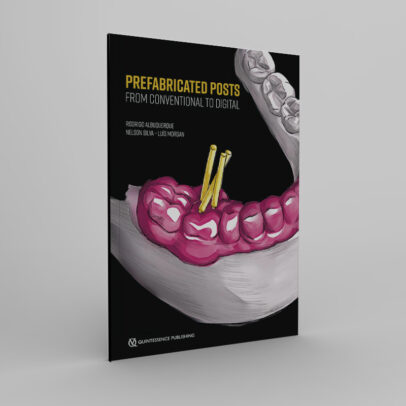 Prefabricated Posts: From Conventional to Digital